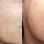 Anti wrinkle treatment NeoFound from Needle Nurse Washington Tyne and Wear