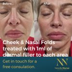 Aesthetic facelift from Needle Nurse Aesthetics