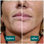 Dermal Filler lower face