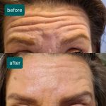 Forehead lines from Needle Nurse Aesthetics Washington