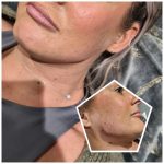 Jawline filler is a great way to add definition, symmetry, balance and:or contour to their jaw.