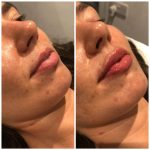 Lip filler Washington