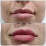 Lippy lips Aesthetics Washington