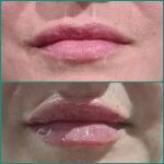 Plump lip. Dermal filler